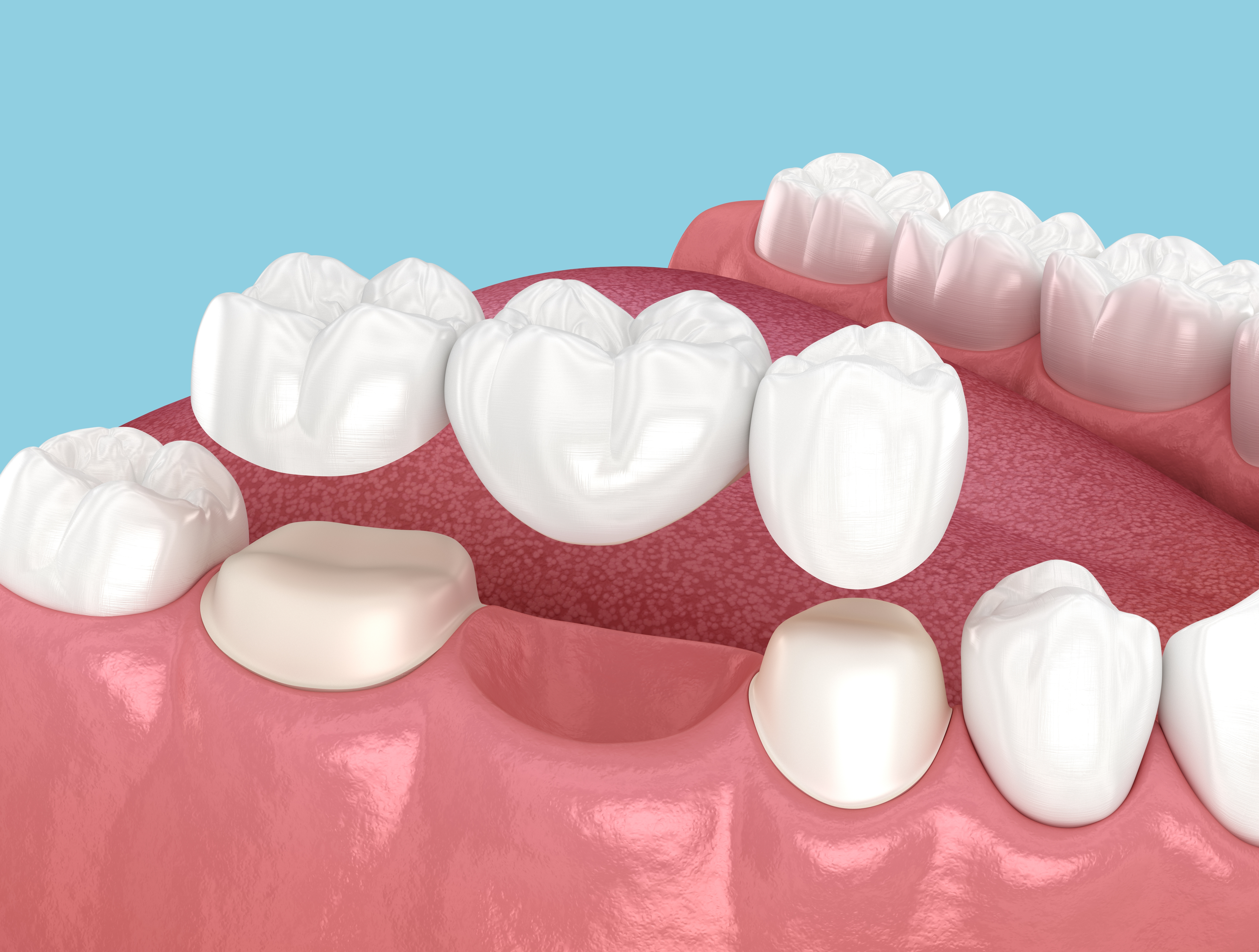Dental bridge restoration example