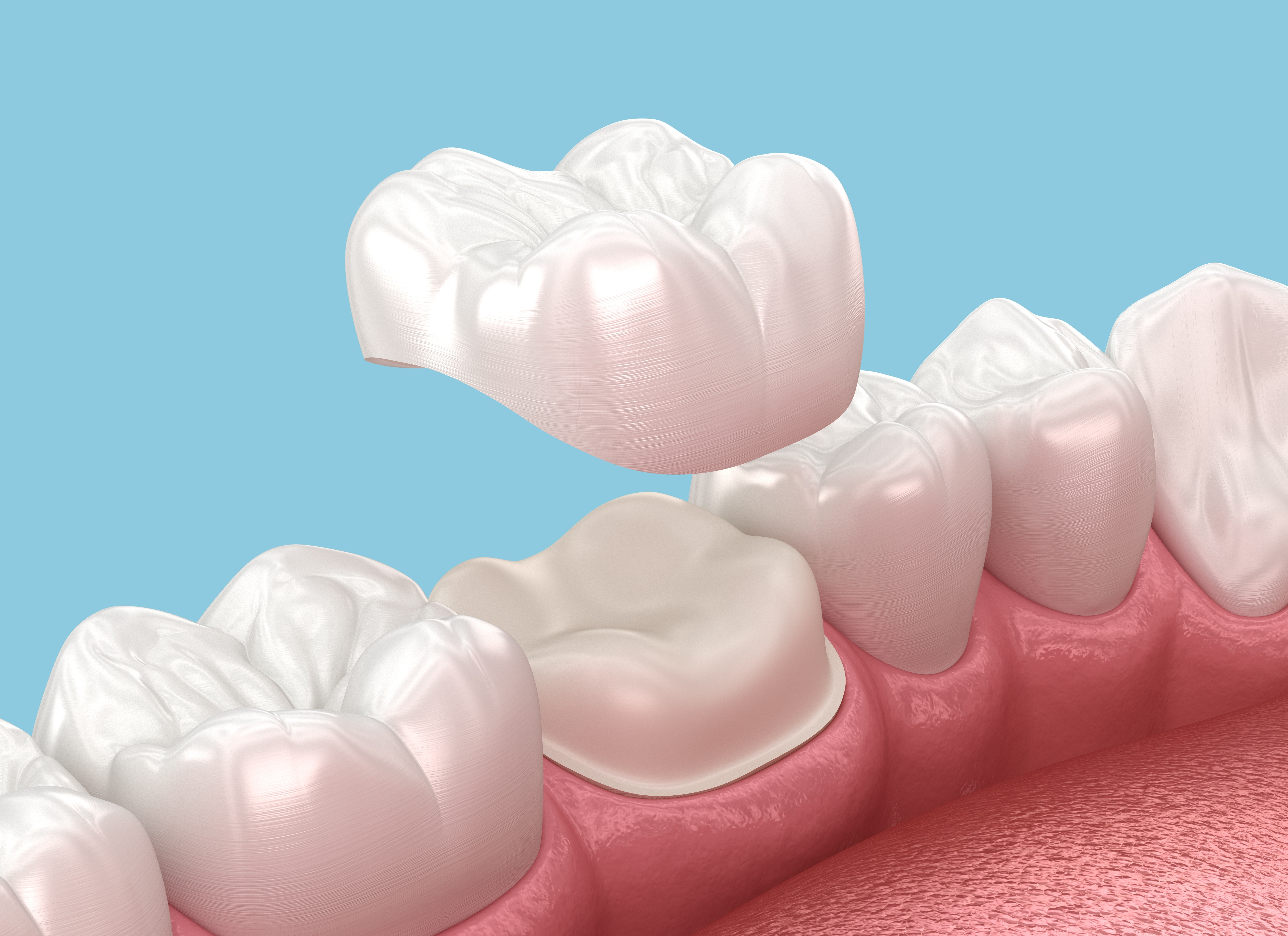 Dental crown restoration example