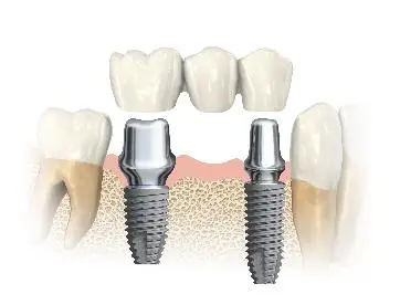 Implant Bridge Example