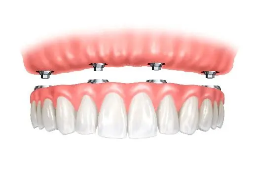Implant Dentures Example