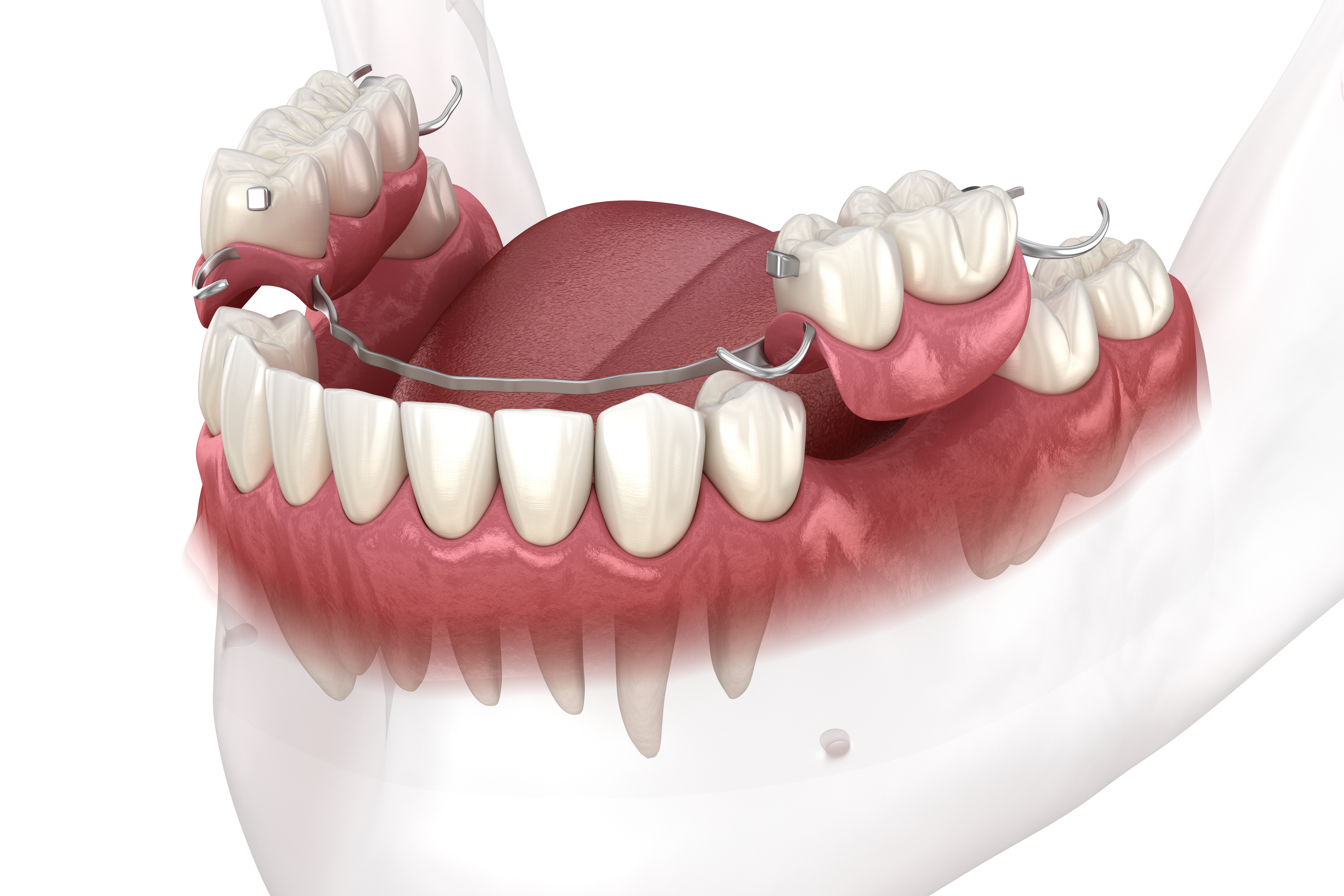 Removable partial denture example