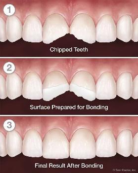 Dental bonding tools